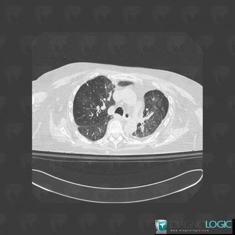 Pulmonary edema, Airways, CT