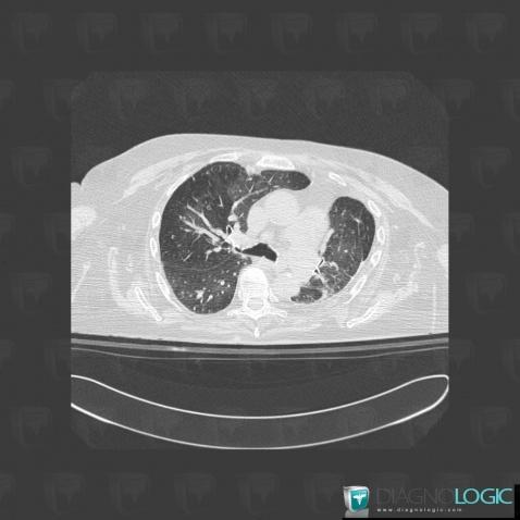 Pulmonary edema, Pulmonary parenchyma, CT