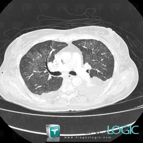 Pulmonary edema, Pulmonary parenchyma, CT