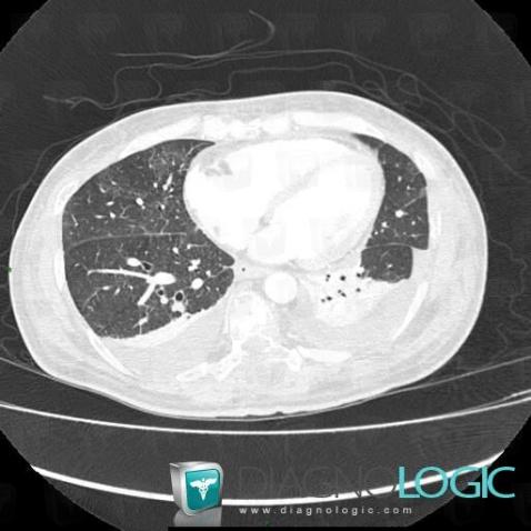 Pulmonary edema, Pulmonary parenchyma, CT