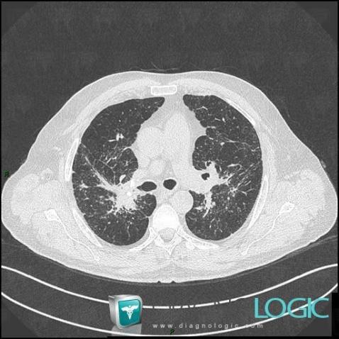 Pulmonary fibrosis, Pulmonary parenchyma, CT