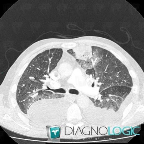 Pulmonary infarction, Pulmonary parenchyma, CT