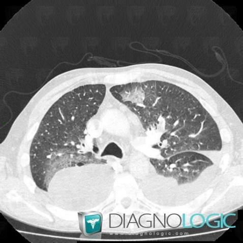 Pulmonary infarction, Pulmonary parenchyma, CT