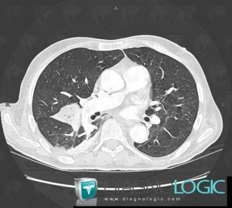 Pulmonary infarction, Pulmonary parenchyma, CT