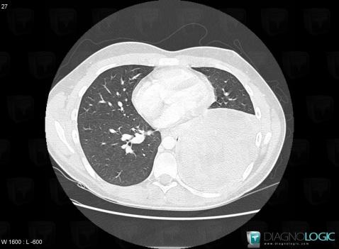 Pulmonary sarcoma, Pulmonary parenchyma, CT