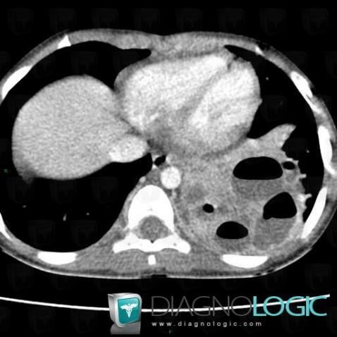 Pulmonary sequestration, Mediastinum, CT