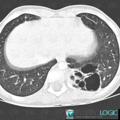 Pulmonary sequestration, Mediastinum, Paraspinal, CT