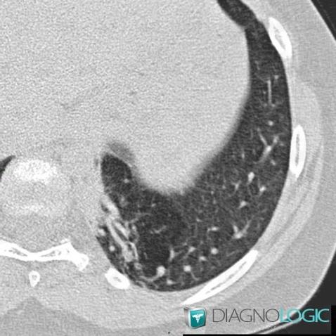 Pulmonary sequestration, Pulmonary parenchyma, CT