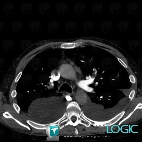 Pulmonary thromboembolism, Pulmonary artery, CT