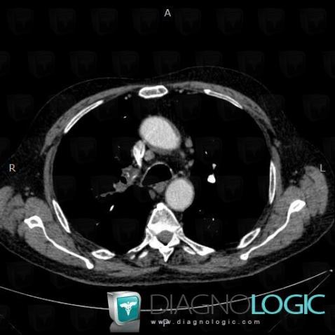 Pulmonary thromboembolism, Pulmonary artery, CT