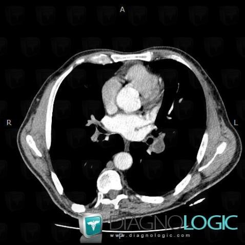 Pulmonary thromboembolism, Pulmonary artery, CT