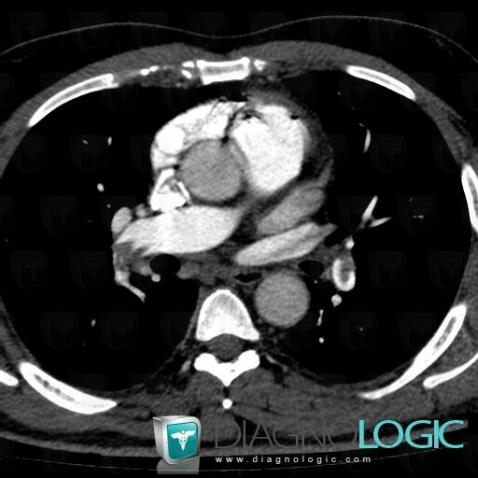 Pulmonary thromboembolism, Pulmonary artery, CT