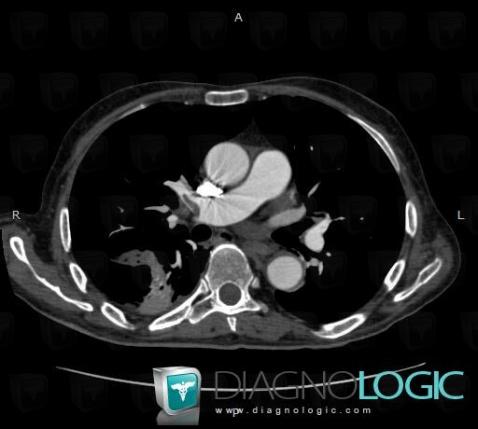 Pulmonary thromboembolism, Pulmonary artery, CT