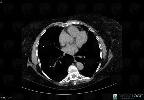 Pulmonary thromboembolism, Pulmonary artery, CT