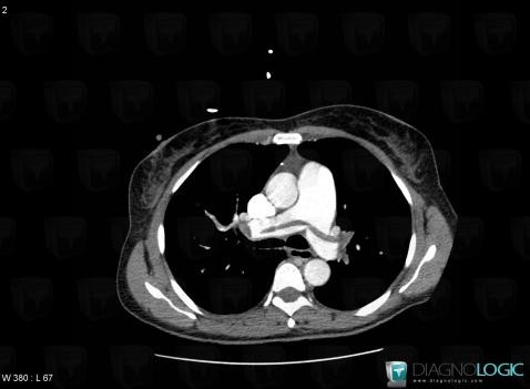 Pulmonary thromboembolism, Pulmonary artery, CT