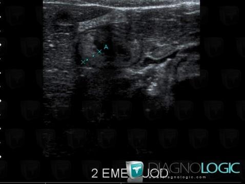 Purpura rhumatoïde , Duodénum, Echographie