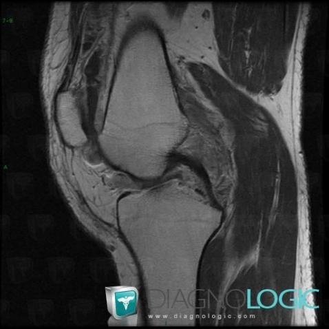 PVNS, Femorotibial joints - Intercondylar notch, MRI