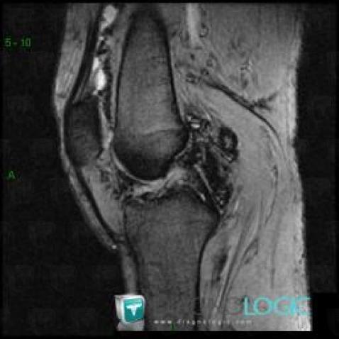 PVNS, Femorotibial joints - Intercondylar notch, MRI