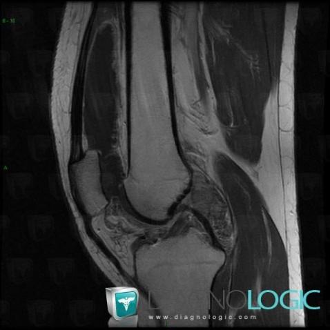 PVNS, Femorotibial joints - Intercondylar notch, MRI