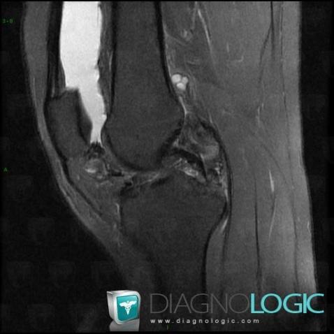 PVNS, Femorotibial joints - Intercondylar notch, MRI