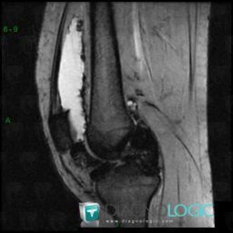 PVNS, Femorotibial joints - Intercondylar notch, MRI