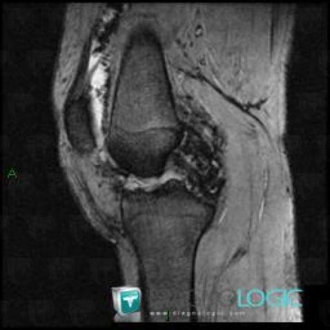 PVNS, Femorotibial joints - Intercondylar notch, MRI