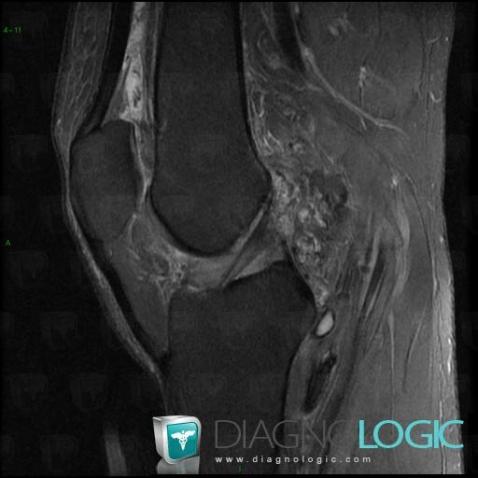 PVNS, Femorotibial joints - Intercondylar notch, Other soft tissues/nerves - Knee, MRI