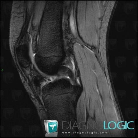 PVNS, Femorotibial joints - Intercondylar notch, Other soft tissues/nerves - Knee, MRI