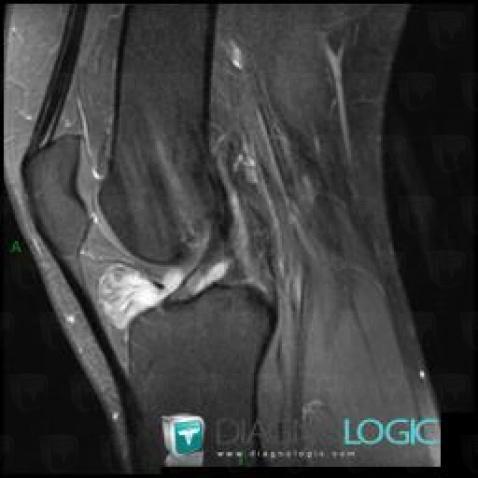 PVNS, Femorotibial joints - Intercondylar notch, Other soft tissues/nerves - Knee, MRI