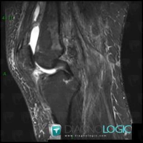 PVNS, Femorotibial joints - Intercondylar notch, Other soft tissues/nerves - Knee, MRI