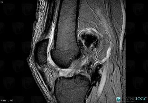 PVNS, Femorotibial joints - Intercondylar notch, Other soft tissues/nerves - Knee, MRI