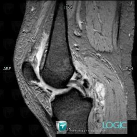 PVNS, Femorotibial joints - Intercondylar notch, Other soft tissues/nerves - Knee, MRI