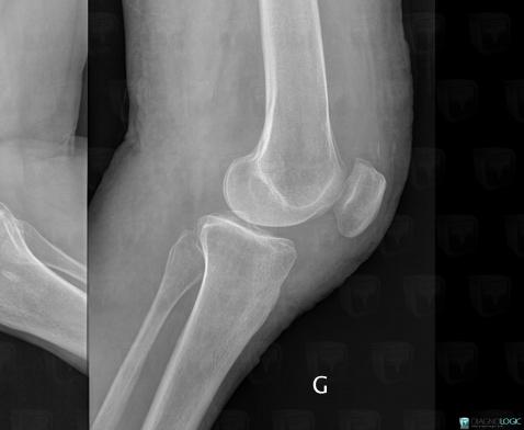 PVNS, Femorotibial joints - Intercondylar notch, Other soft tissues/nerves - Knee, X rays