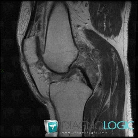 PVNS, Femorotibial joints - Intercondylar notch, Patellofemoral joint, MRI