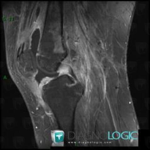 PVNS, Femorotibial joints - Intercondylar notch, Patellofemoral joint, MRI