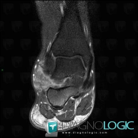 PVNS, Other soft tissues/nerves - Ankle, MRI