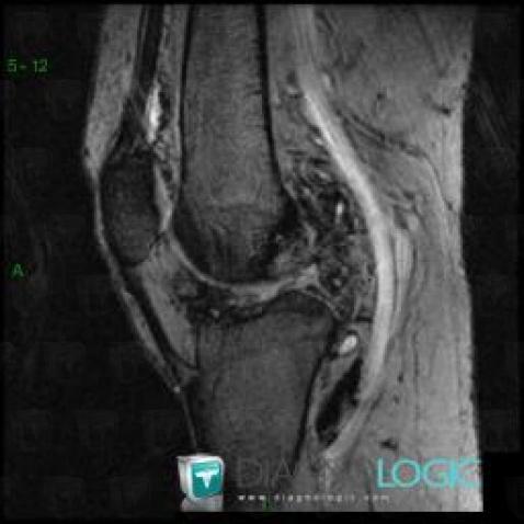 PVNS, Other soft tissues/nerves - Knee, MRI