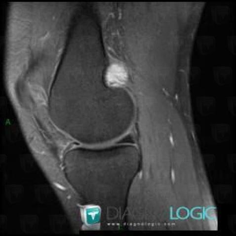 Radiology case : PVNS (MRI) - Diagnologic