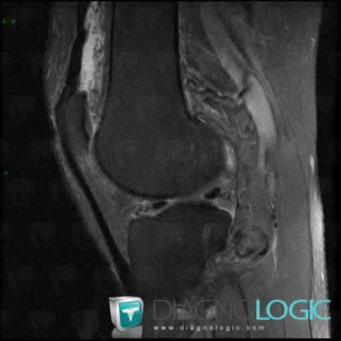 PVNS, Patellofemoral joint, MRI