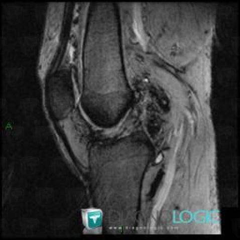 PVNS, Patellofemoral joint, MRI