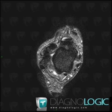 PVNS, Tibio/fibulo talar joint, MRI