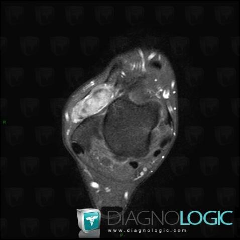 PVNS, Tibio/fibulo talar joint, MRI