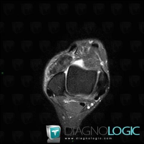 PVNS, Tibio/fibulo talar joint, Other soft tissues/nerves - Ankle, MRI