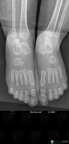 Pycnodysostosis, Phalanx / Sesamoid bones - Foot, X rays