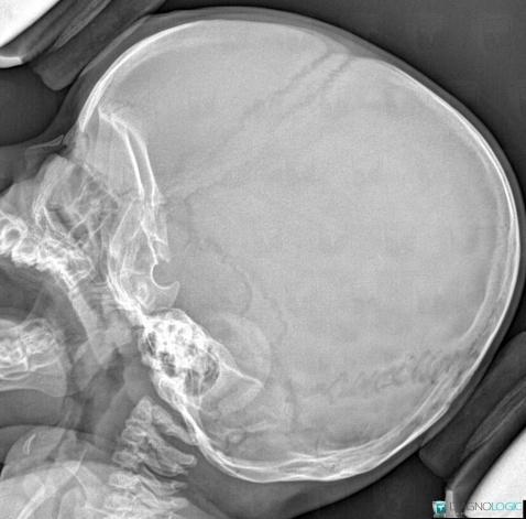 Pycnodysostosis, Skull vault, X rays