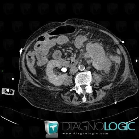Cas radiologie : Pyélonéphrite (Scanner) - Diagnologic