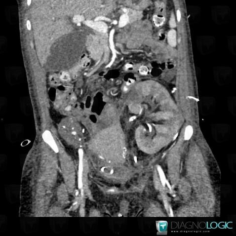 Pyelonephritis, Kidney, CT