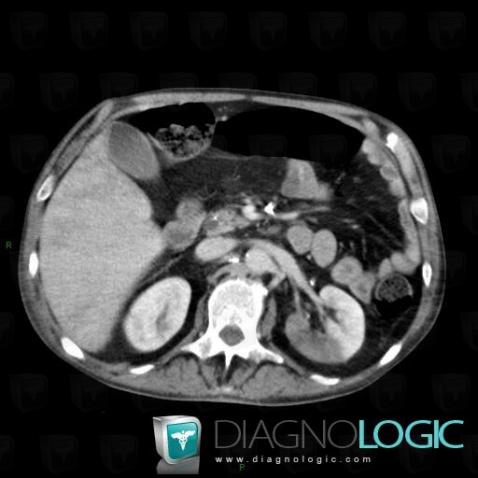 Pyelonephritis, Kidney, CT