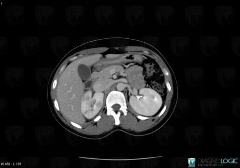 Pyelonephritis, Kidney, CT