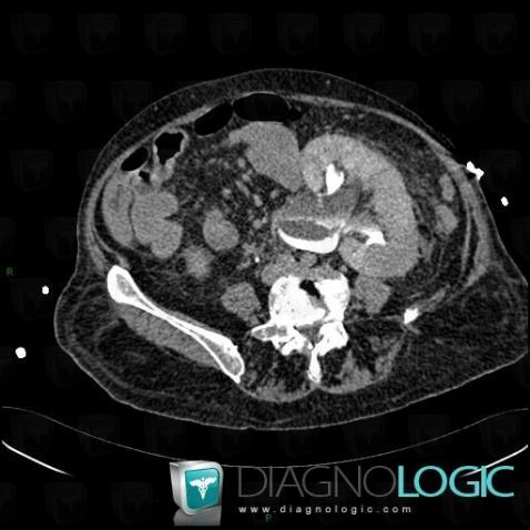 Radiology case : Pyelonephritis (CT) - Diagnologic